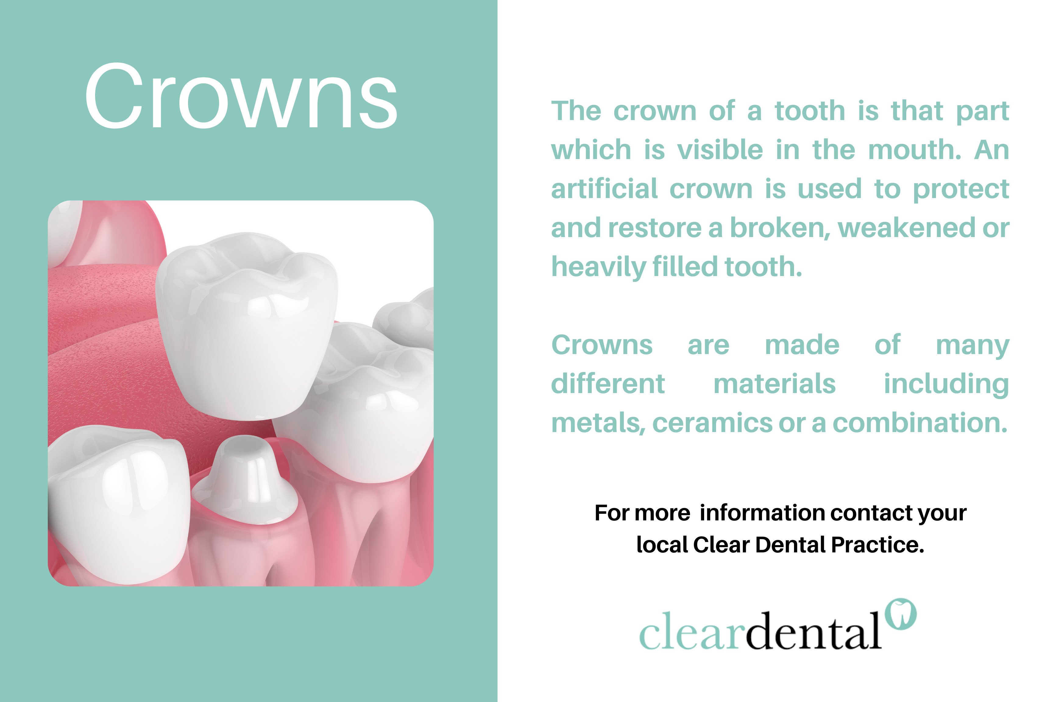 Crowns Clear Dental