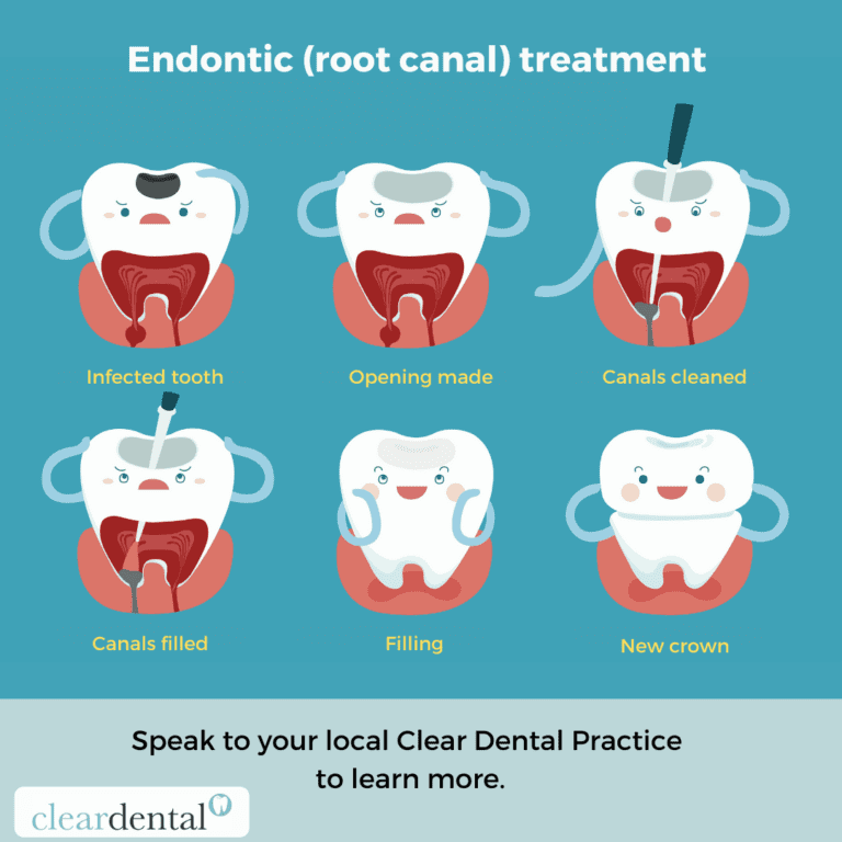Endodontic (root canal) treatment Clear Dental